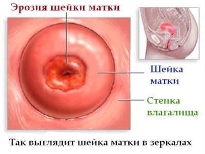 Эрозия шейки матки