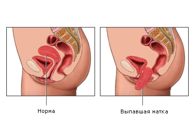 Опущение матки